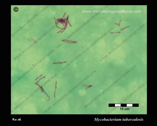 acid-fast stain, acid-fast rods in sputum